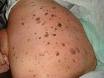 Queratosis seborreica | Patologias Dermatologicas